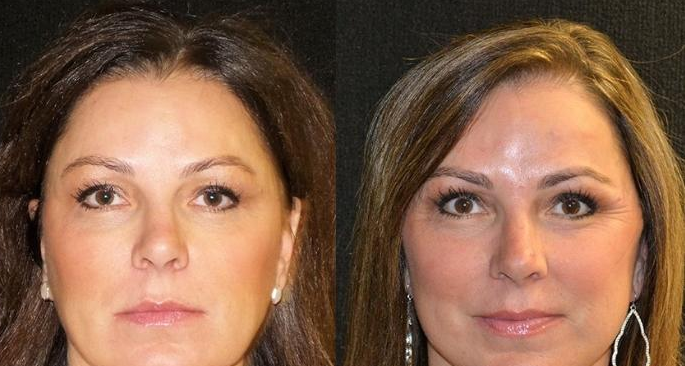 Discover Your True Beauty with Ethnic Rhinoplasty in Los Angeles post thumbnail image
